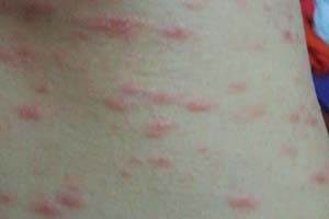 如何预防玫瑰糠疹复发呢？